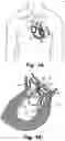 Fig. 02 - Medical system, a device for collecting chordae and/or leaflets and a method therefor