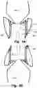 Fig. 04 - Medical system, a device for collecting chordae and/or leaflets and a method therefor