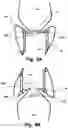 Fig. 07 - Medical system, a device for collecting chordae and/or leaflets and a method therefor