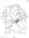Fig. 02 - PROSTHETIC HEART VALVE DELIVERY SYSTEM