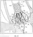 Fig. 10 - PROSTHETIC HEART VALVE DELIVERY SYSTEM