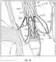 Fig. 11 - PROSTHETIC HEART VALVE DELIVERY SYSTEM