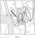 Fig. 13 - PROSTHETIC HEART VALVE DELIVERY SYSTEM