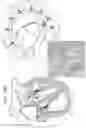 Fig. 33 - Annuloplasty technologies