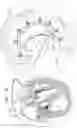Fig. 34 - Annuloplasty technologies