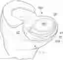 Fig. 01 - Two-piece floating joint replacement device with a rigid backing material