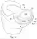Fig. 07 - Two-piece floating joint replacement device with a rigid backing material