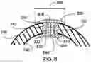 Fig. 05 - System and method for installing an annular repair rivet through a vertebral body port
