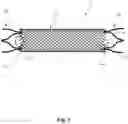 Fig. 02 - BRAIDED STENT SYSTEM WITH ONE OR MORE EXPANSION RINGS