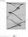 Fig. 04 - BRAIDED STENT SYSTEM WITH ONE OR MORE EXPANSION RINGS