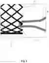 Fig. 05 - BRAIDED STENT SYSTEM WITH ONE OR MORE EXPANSION RINGS