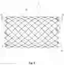 Fig. 09 - BRAIDED STENT SYSTEM WITH ONE OR MORE EXPANSION RINGS