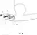Fig. 10 - BRAIDED STENT SYSTEM WITH ONE OR MORE EXPANSION RINGS