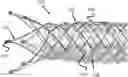 Fig. 01 - Vessel Prosthesis