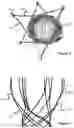 Fig. 03 - Vessel Prosthesis
