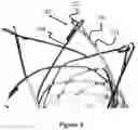 Fig. 06 - Vessel Prosthesis