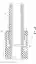 Fig. 04 - ENDOVASCULAR CATHETER WITH DELIVERY SYSTEM SEPARATELY ASSEMBLED TO STENT GRAFT SYSTEM