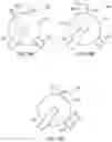 Fig. 17 - Selectively moveable valve elements for aspiration and irrigation circuits