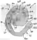 Fig. 01 - Ear splint to correct congenital ear deformities