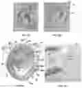 Fig. 03 - Ear splint to correct congenital ear deformities