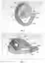 Fig. 04 - Ear splint to correct congenital ear deformities