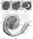 Fig. 05 - Ear splint to correct congenital ear deformities