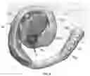 Fig. 06 - Ear splint to correct congenital ear deformities