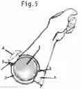 Fig. 04 - Dome Bandage