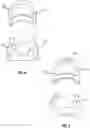 Fig. 05 - ARM POSITIONING CRADLE FOR SUPINE AND BEACH CHAIR POSITION