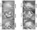 Fig. 05 - GENE THERAPY FOR TREATING FAMILIAL HYPERCHOLESTEROLEMIA
