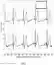 Fig. 07 - Electrocardiogram signal detection