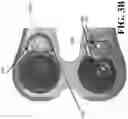Fig. 06 - MEDICAL IMPLANT SYSTEMS AND METHODS OF USE THEREOF