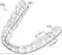 Fig. 01 - DENTAL APPLIANCE REINFORCEMENT
