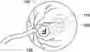 Fig. 01 - Compensating corneal opacity