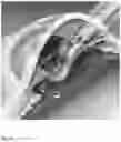 Fig. 08 - Compensating corneal opacity