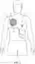 Fig. 02 - LVAD FIXATION AND INFECTION MANAGEMENT