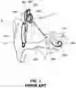 Fig. 02 - Hidden cochlear implant system