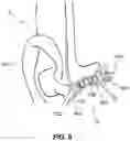 Fig. 07 - Hidden cochlear implant system