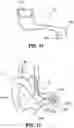 Fig. 09 - Hidden cochlear implant system