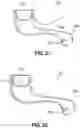 Fig. 13 - Hidden cochlear implant system