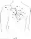 Fig. 02 - Assessing intra-cardiac activation patterns