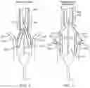 Fig. 05 - Prosthetic heart valve