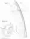 Fig. 08 - METHOD FOR MANUFACTURING A LOW-PROFILE INTERCRANIAL DEVICE AND THE LOW-PROFILE INTERCRANIAL DEVICE MANUFACTURED THEREBY