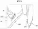 Fig. 02 - Device for enhancing rigidity of vehicle body