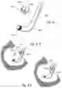 Fig. 10 - Methods and apparatus for treating disorders of the ear nose and throat