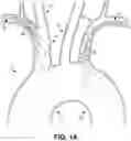 Fig. 02 - SYSTEMS AND METHODS FOR PROVIDING DISTAL EMBOLIC PROTECTION