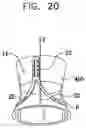 Fig. 35 - Valve suturing and implantation procedures
