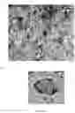 Fig. 07 - Detection and Treatment of Malignant Tumours in the CNS