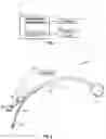 Fig. 02 - System and method for detecting agitation, discomfort and/or self-extubation during intubation