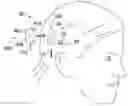 Fig. 01 - Cochlear implants, magnets for use with same and magnet retrofit methods